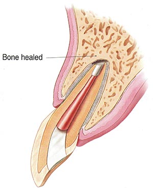 Apicoectomy Healed