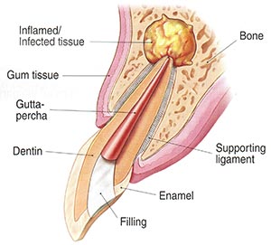 Apicoectomy Infected Tissue