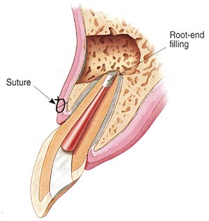 Apicoectomy Suture