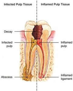 pulp_infection - La Jolla Endodontics