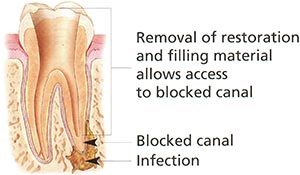 Retreatment Process