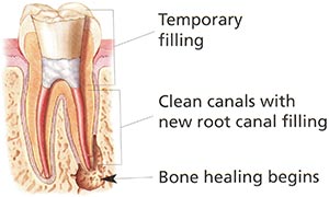 Retreatment Temporary Filing