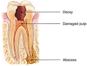 Root Canal Step 1