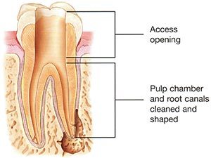 Root Canal Step 2