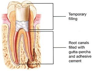 Root Canal Step 3