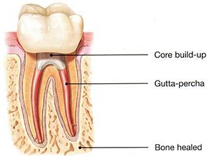 Root Canal Step 4