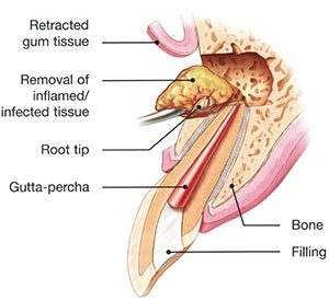 Apicoectomy Surgery