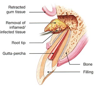 Apicoectomy Surgery