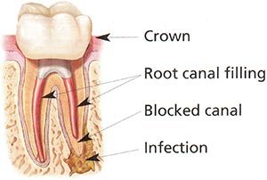 Root Infection