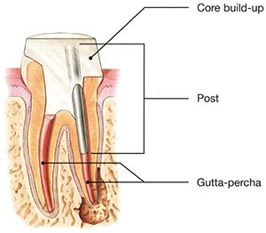 Tooth Post